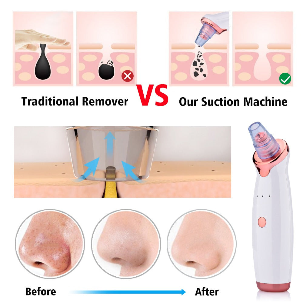 Beverlia Beauty Products | Blackhead remover Pore vacuum Blackhead remover machine Pore vacuum blackhead remover Pore cleaning Best pore vacuum 2020 Pore vacuum blackhead remover Blackhead remover vacuum Blackhead removal Nose blackhead remover tool Nose blackhead remover strips Nose blackhead remover machine